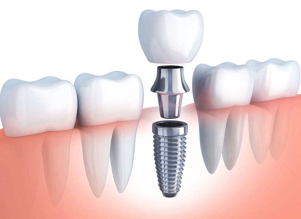 img-implant-1